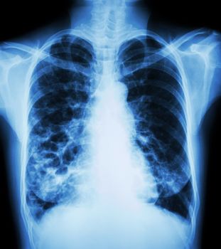 "Bronchiectasis" X-ray chest show : multiple lung bleb and cyst due to chronic infection