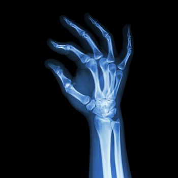 film x-ray human's hand and OK symbol