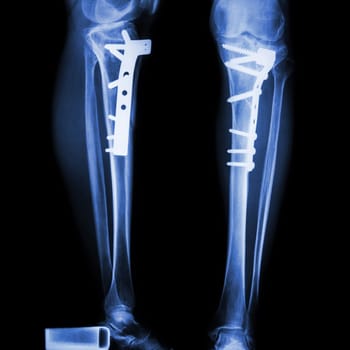 fracture tibia(leg bone). It was operated and internal fixed by plate&screw