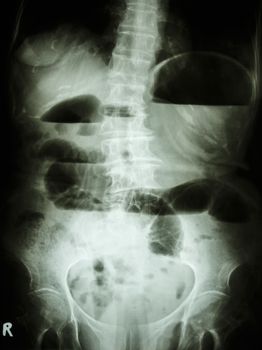 Film X-ray abdomen upright show small bowel dilated and air-fluid level in small bowel due to small bowel obstruction