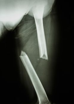 Film X-ray Left femur(left thigh) show complete fracture shaft of femur and displace