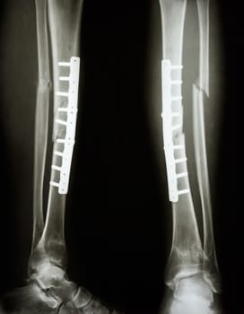 film leg AP/lateral : show fracture shaft of tibia and fibular (leg's bone). patient was operated and insert plate and screw for fix leg's bone