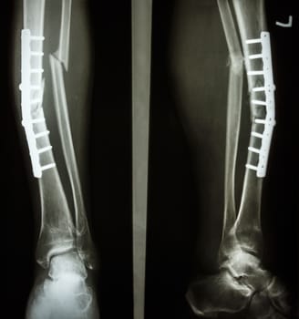 film leg AP/lateral : show fracture shaft of tibia and fibular (leg's bone). patient was operated and insert plate and screw for fix leg's bone