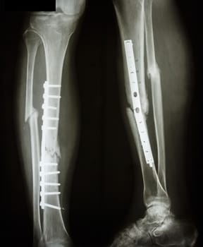 film leg AP/lateral : show fracture shaft of tibia and fibular (leg's bone). patient was operated and insert plate and screw for fix leg's bone