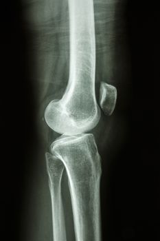 Flim X-ray knee lateral : show normal human's knee joint