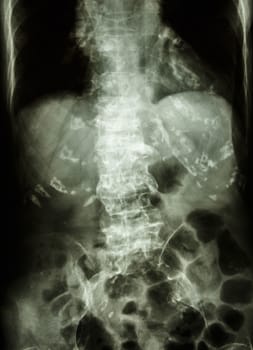 "Spondylosis" Film x-ray abdomen of old aged human : show spine with spur and calcification at multiple bone & vessels