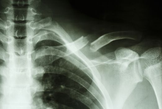 Film X-ray show complete fracture middle 1/3 left clavicle