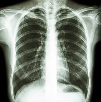 Film chest x-ray PA upright : show normal human's chest