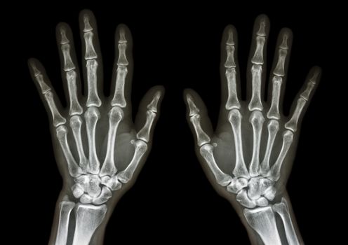 film x-ray both hand AP : show normal human's hands on black background (isolated)