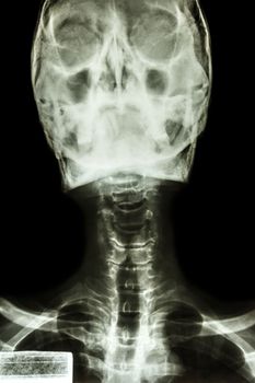 Film x-ray show normal human's skull and cervical spine