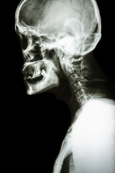 Film x-ray Skull lateral : show normal human's skull and cervical spine