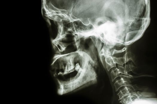 Film x-ray Skull lateral : show normal human's skull and blank area at left side