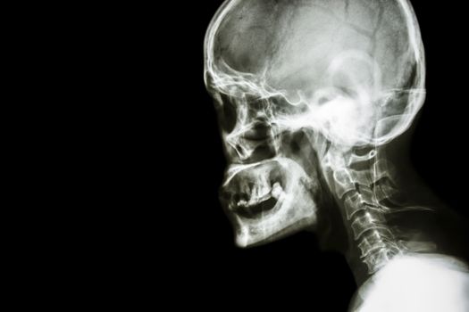 Film x-ray Skull lateral : show normal human's skull and cervical spine and blank area at left side