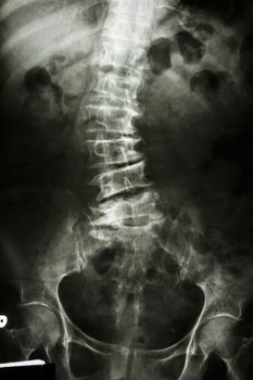 "Scoliosis" film x-ray lumbar spine AP : show spine bend in old aged patient