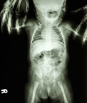film x-ray show body of child and adult is holding at both child's arm