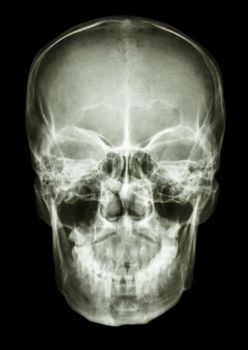 film x-ray skull AP : show normal human's skull