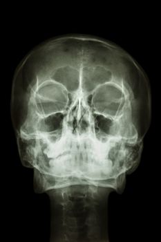 film x-ray skull : show normal human's skull and cervical spine