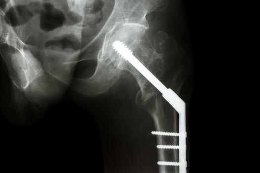 film x-ray left hip : show fracture neck of femur(thigh's bone). patient was operated and fixed bone by screw