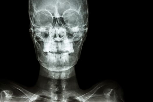 film x-ray Skull AP : show normal human's skull and blank area at right side