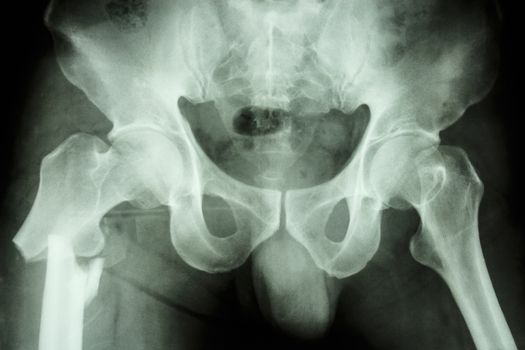 film x-ray pelvis AP : show fracture right femur (thigh's bone)