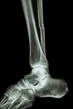 film x-ray ankle lateral : show complete fracture shaft of fibula (leg's bone)