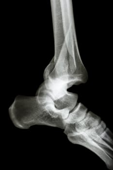 film x-ray ankle AP/Lateral : show fracture tibia & fibula (leg's bone) and ankle dislocation