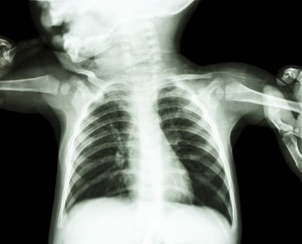 film x-ray show body of child and adult is holding at both child's arm