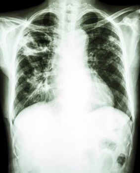 film chest x-ray show cavity at right upper lung due to Mycobacterium tuberculosis infection (Pulmonary Tuberculosis)