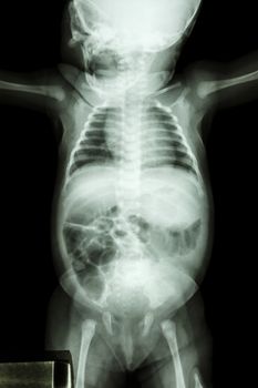 film x-ray whole infant's body : show normal infant's body