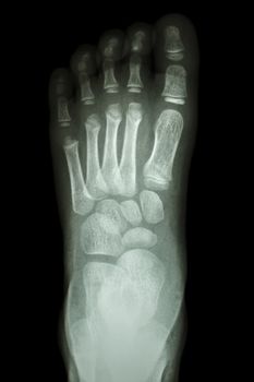 film x-ray foot AP : show normal child's foot