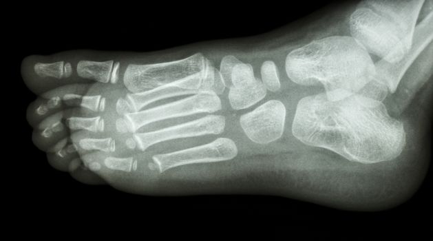 film x-ray foot lateral : show normal child's foot