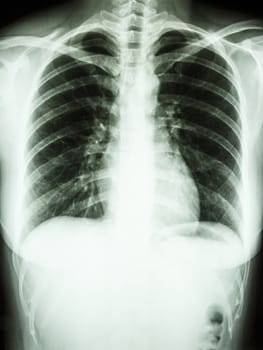 Film chest X-ray PA upright show normal human' chest