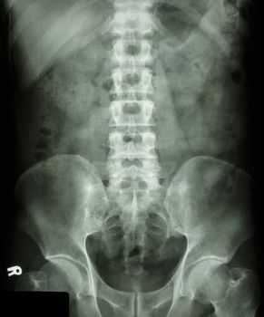 film X-ray L-S spine AP(Antero-posterior) show normal human's lumbosacral spine (L-S spine)