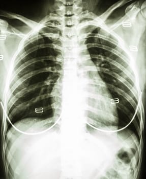 film chest x-ray : show normal woman's chest with bra