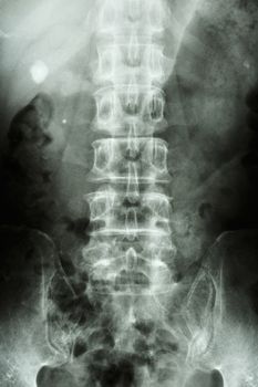 film x-ray KUB(Kidney-ureter-bladder) show right renal stone (round shape at right side)