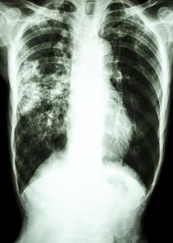 film chest x-ray show alveolar infiltrate at right lung due to Mycobacterium tuberculosis infection (Pulmonary Tuberculosis)