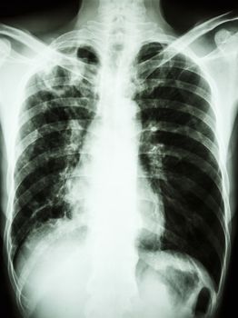 film chest x-ray show cavity at right upper lung due to Mycobacterium tuberculosis infection (Pulmonary Tuberculosis)