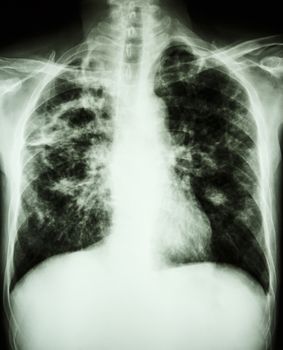 film chest x-ray show cavity at right lung,fibrosis & interstitial & patchy infiltrate at both lung due to Mycobacterium tuberculosis infection (Pulmonary Tuberculosis)