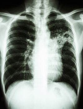 film chest x-ray show alveolar infiltrate at left middle lung due to Mycobacterium tuberculosis infection (Pulmonary Tuberculosis)