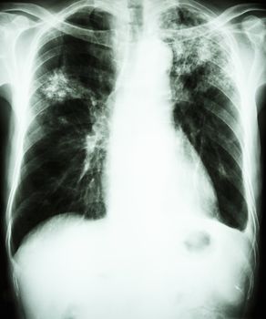 film chest x-ray show alveolar infiltrate at left upper lung and right middle lung due to Mycobacterium tuberculosis infection (Pulmonary Tuberculosis)