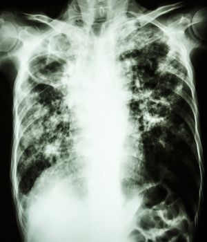 film chest x-ray show cavity at right lung,fibrosis & interstitial & patchy infiltrate at both lung due to Mycobacterium tuberculosis infection (Pulmonary Tuberculosis)