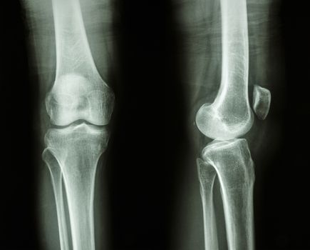 Film x-ray knee AP/lateral : show normal human's knee