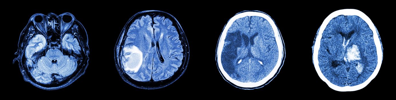 Collection CT scan of brain and multiple disease (Left to Right : Normal brain,Brain tumor,Cerebral infarction,Intracerebral hemorrhage)