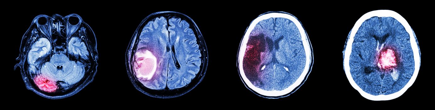 Collection CT scan of brain and multiple disease (Left to Right : Normal brain,Brain tumor,Cerebral infarction,Intracerebral hemorrhage)
