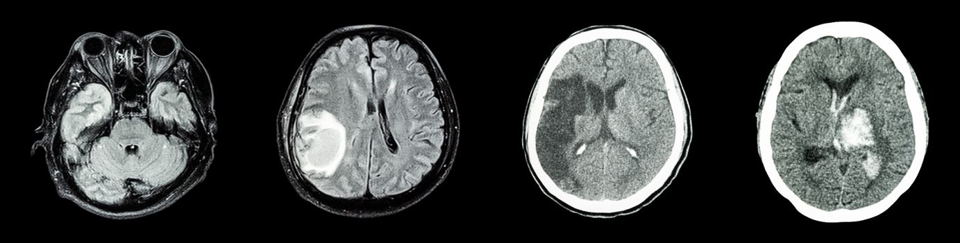 Collection CT scan of brain and multiple disease (Left to Right : Normal brain,Brain tumor,Cerebral infarction,Intracerebral hemorrhage)