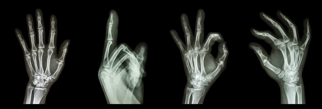 Collection X-ray symbol hands