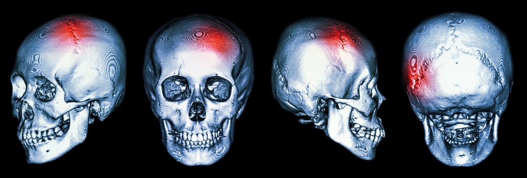 CT scan of human skull and 3D with Stroke (cerebrovascular accident)