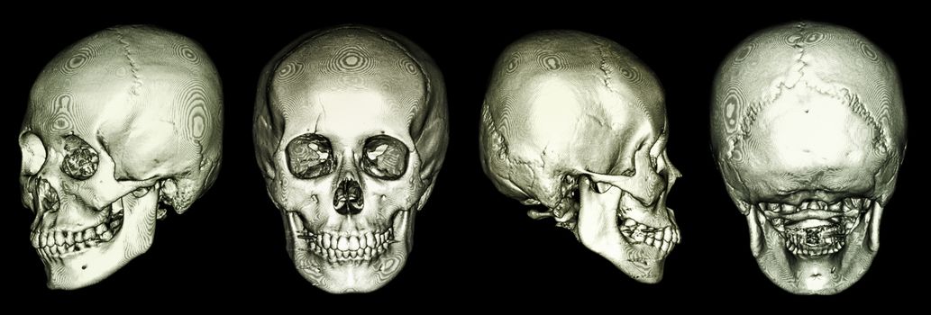 CT scan of human skull and 3D