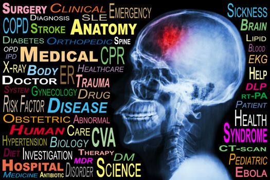 X-ray skull and "Stroke" and Medical word cloud