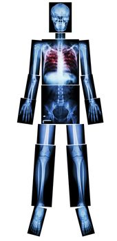 Pulmonary Tuberculosis(TB)(X-ray whole body : head skull neck spine shoulder arm elbow forearm wrist hand finger thorax chest heart lung rib back abdomen pelvis hip thigh knee leg ankle foot heel toe)